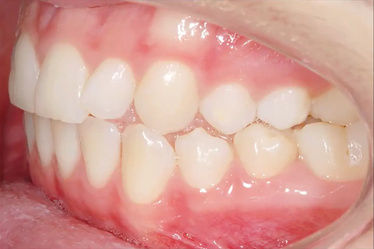 Zähne und Biss vor kieferorthopädischer Zahnkorrektur nach dem ganzheitlichen Konzept KFO360°