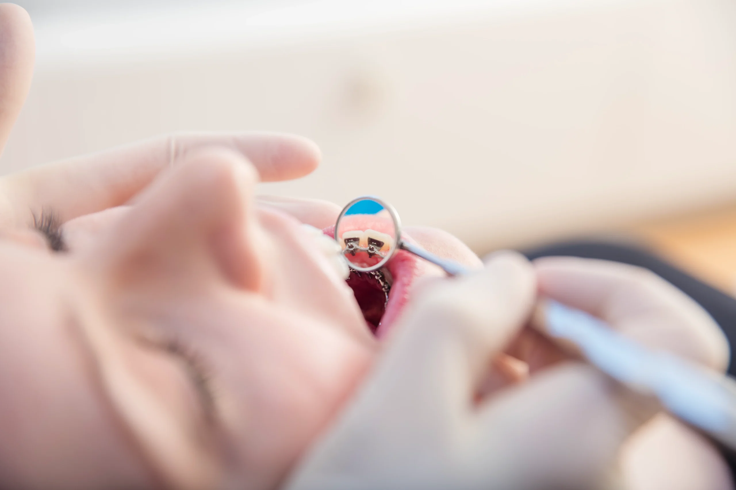 eine Lingualspange bei einer Erwachsenen wird mit einem Spiegel gezeigt