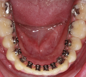 effektive Zahnbegradigung mit innenliegender Zahnspange, einer sogenannte Lingualtechnik
