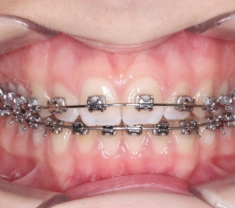 Zahnkorrektur mit auf Zähnen geklebten Metallbrackets
