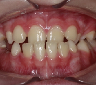 Kieferfehlstellung progener Unterkiefer