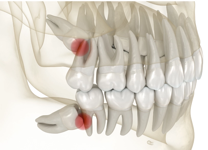Wisdom Teeth (Third Molars) – Why Removal Is Often Beneficial