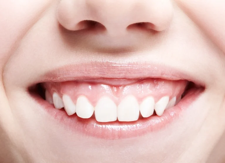 Gummy Smile